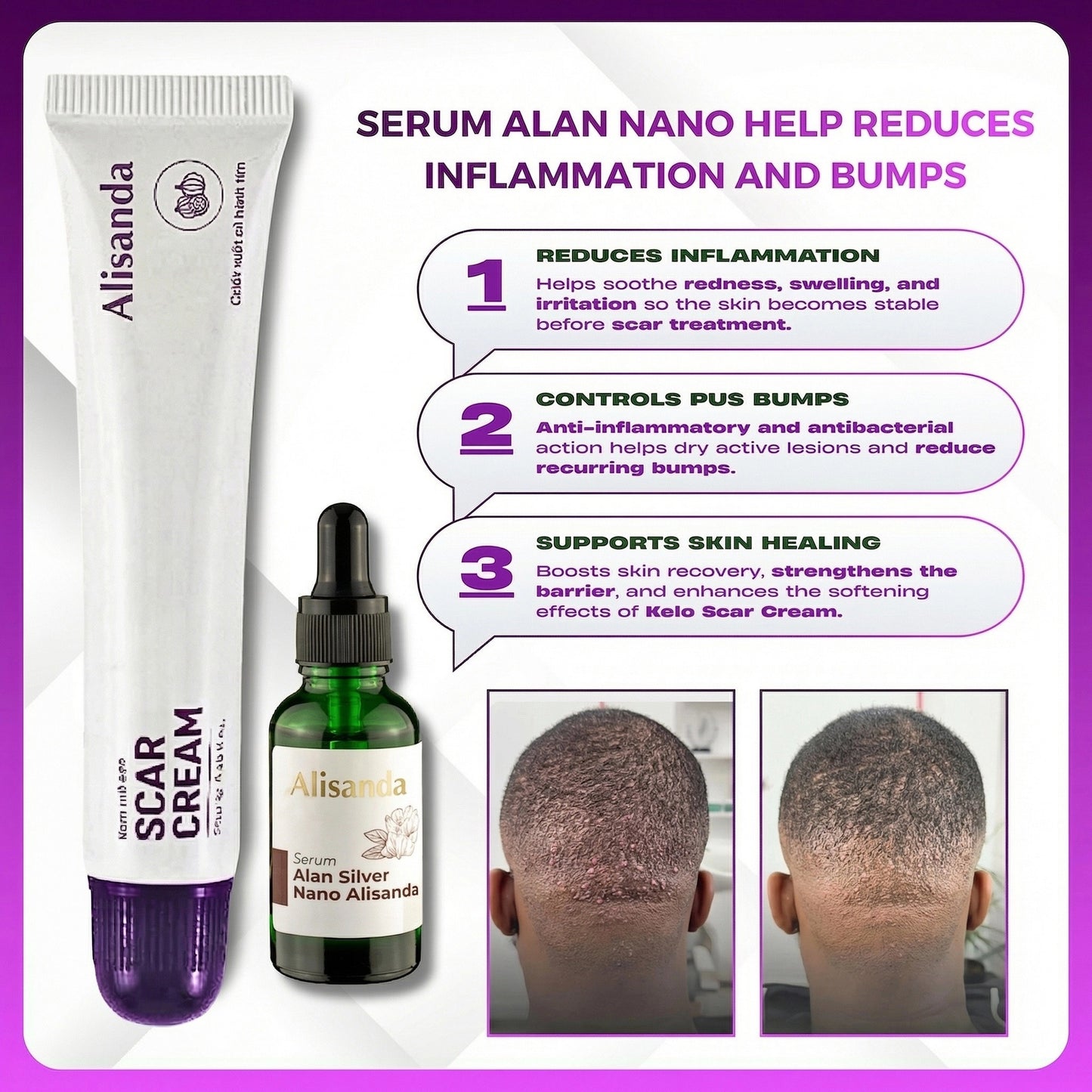 Alisanda Scar Cream – Advanced Treatment for Raised & Keloid Scars