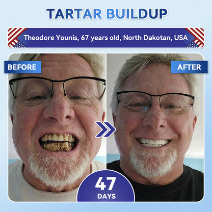 SmileFitPro® 🦷 Tideglusib Fast‑Dissolving Tooth & Gum Repair Oral Strips ✨