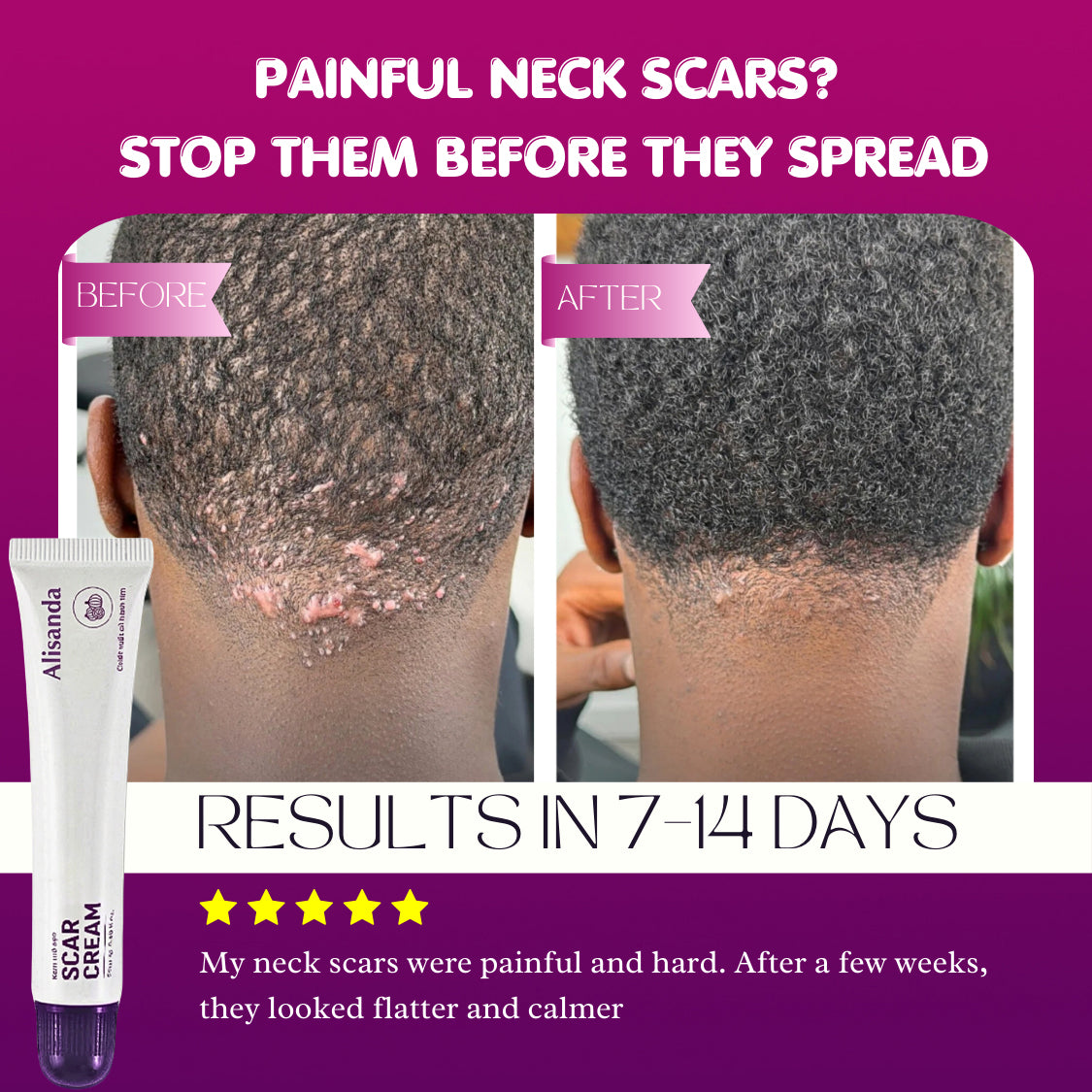 Alisanda Scar Cream – Advanced Treatment for Raised & Keloid Scars