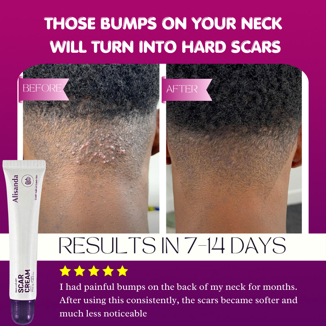 Alisanda Scar Cream – Advanced Treatment for Raised & Keloid Scars