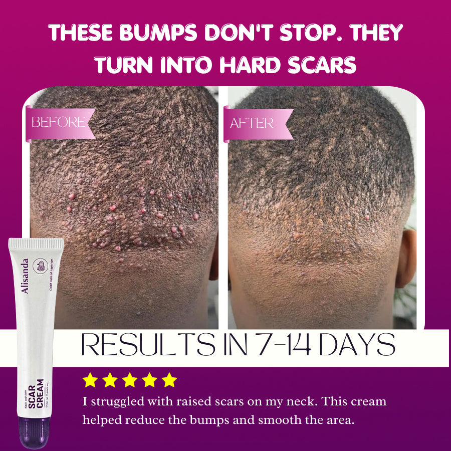 Alisanda Scar Cream – Advanced Treatment for Raised & Keloid Scars