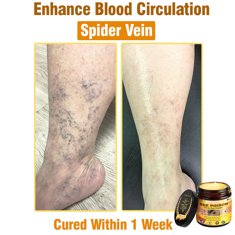 （🔥LAST DAY SALE-80% OFF)🥇👩‍⚕️LOVILDS™ Bee Poison All-in-One Cream US Dermatologist Approved 👨‍⚕️