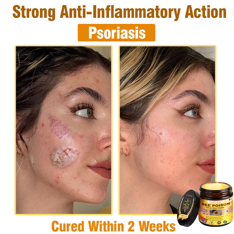 （🔥LAST DAY SALE-80% OFF)🥇👩‍⚕️LOVILDS™ Bee Poison All-in-One Cream US Dermatologist Approved 👨‍⚕️