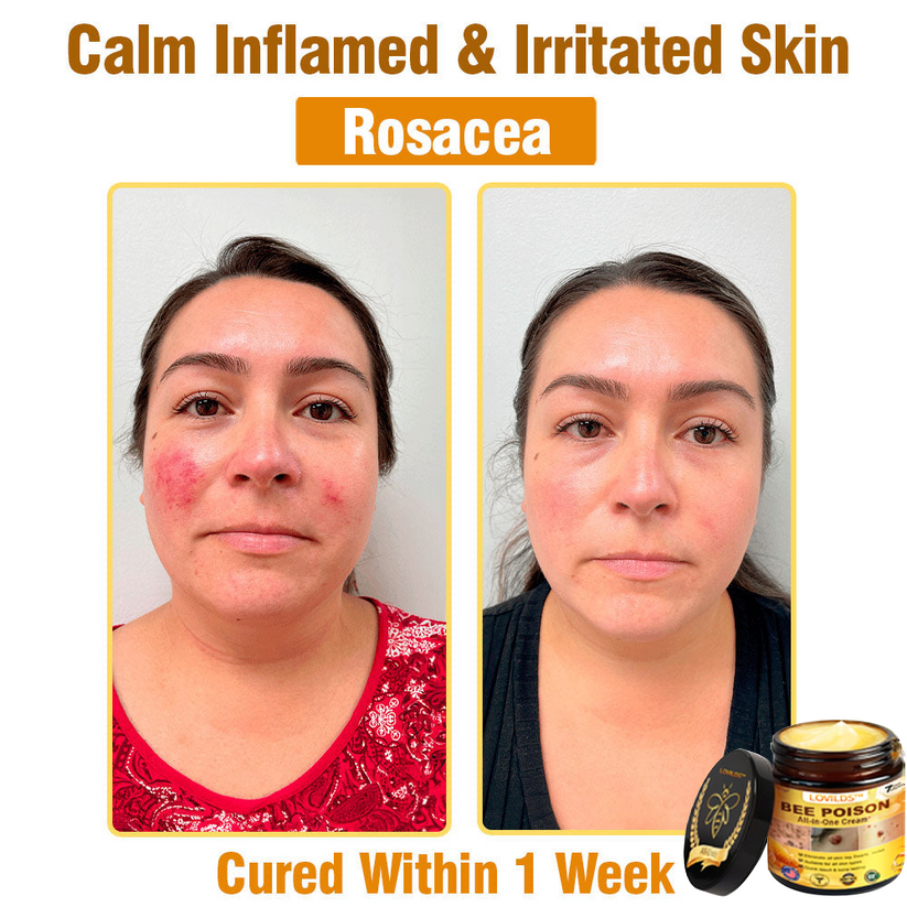 （🔥LAST DAY SALE-80% OFF)🥇👩‍⚕️LOVILDS™ Bee Poison All-in-One Cream US Dermatologist Approved 👨‍⚕️