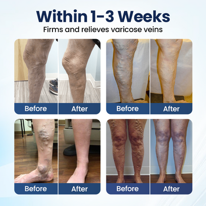 Vaxflite® Deep Vein Repair Microneedle Patch