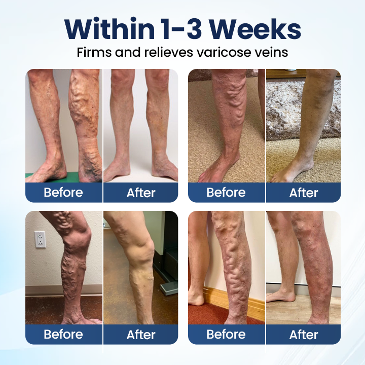 Vaxflite® Deep Vein Repair Microneedle Patch