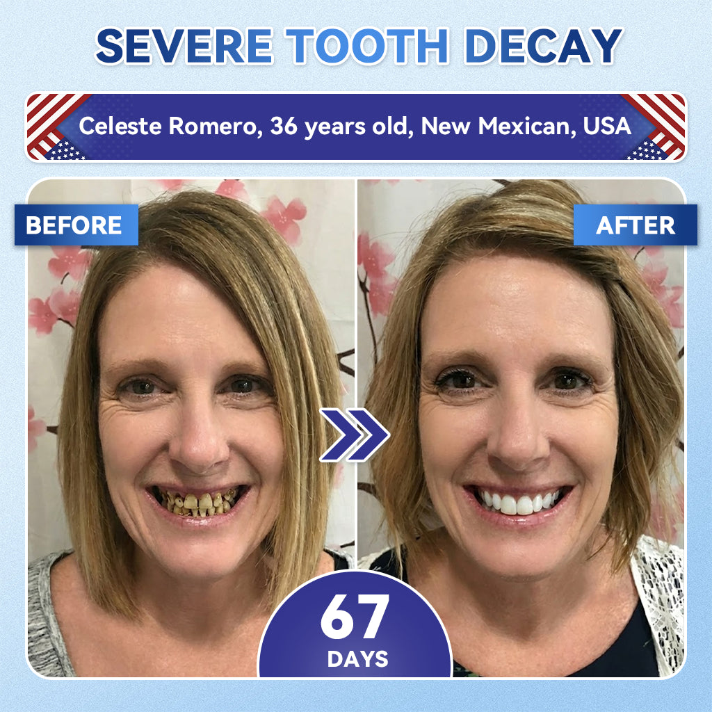 SmileFitPro® 🦷 Tideglusib Fast‑Dissolving Tooth & Gum Repair Oral Strips ✨