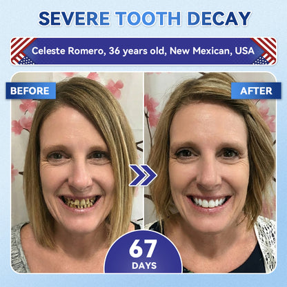 SmileFitPro® 🦷 Tideglusib Fast‑Dissolving Tooth & Gum Repair Oral Strips ✨
