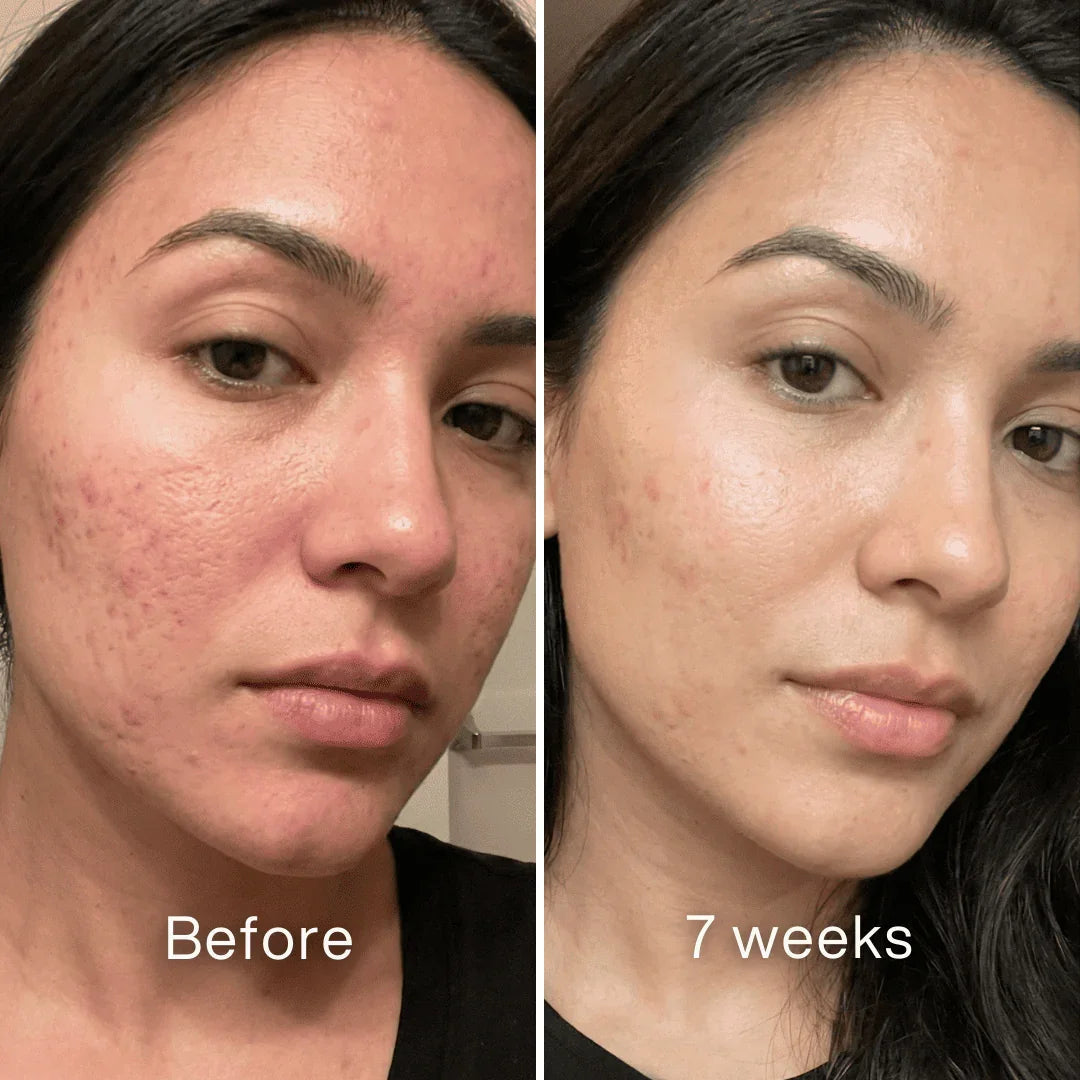 Cheemex™ Clinical Acne Scar Remodeling Stick