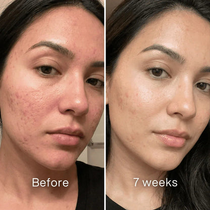 Cheemex™ Clinical Acne Scar Remodeling Stick