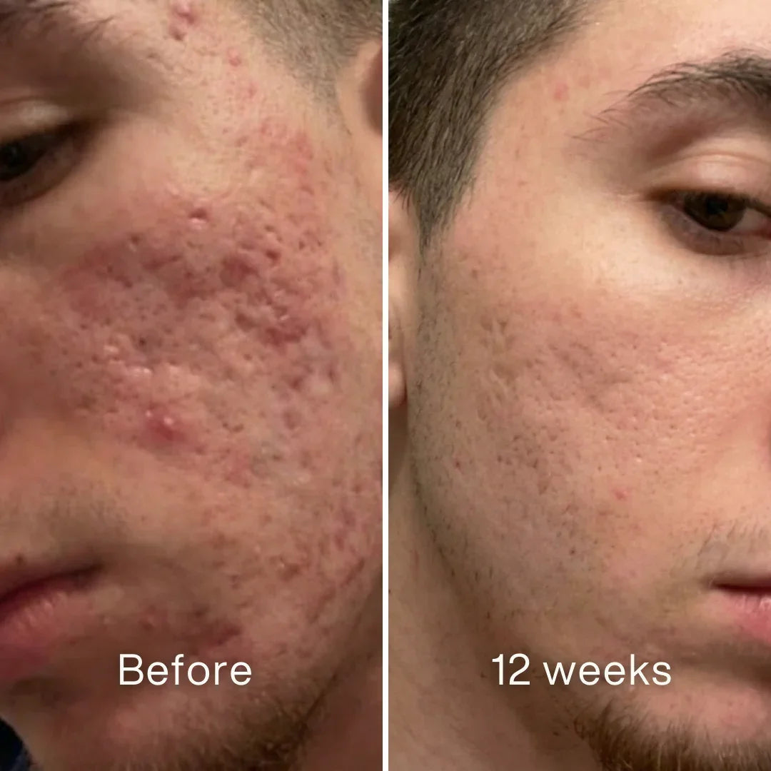 Cheemex™ Clinical Acne Scar Remodeling Stick