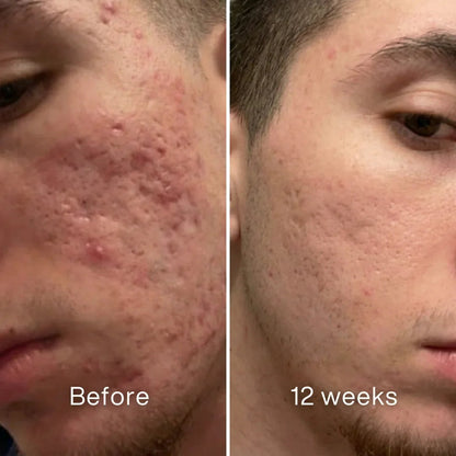 Cheemex™ Clinical Acne Scar Remodeling Stick