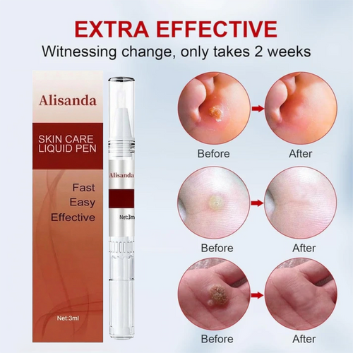 Precision Wart Remover Targeted Kit