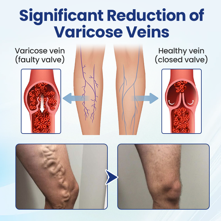 Vaxflite® Deep Vein Repair Microneedle Patch