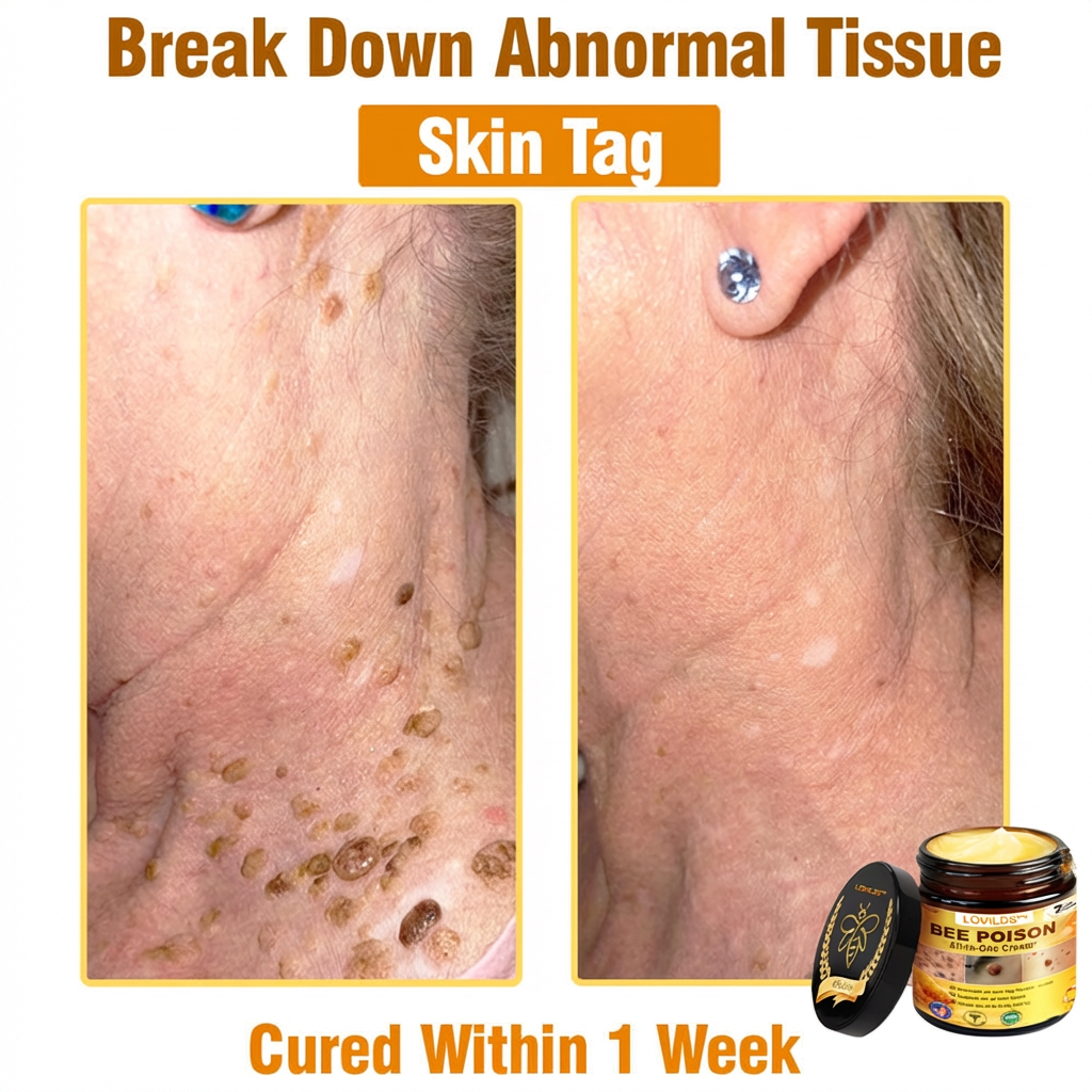 （🔥LAST DAY SALE-80% OFF)🥇👩‍⚕️LOVILDS™ Bee Poison All-in-One Cream US Dermatologist Approved 👨‍⚕️