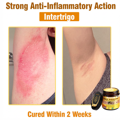 （🔥LAST DAY SALE-80% OFF)🥇👩‍⚕️LOVILDS™ Bee Poison All-in-One Cream US Dermatologist Approved 👨‍⚕️