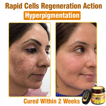 （🔥LAST DAY SALE-80% OFF)🥇👩‍⚕️LOVILDS™ Bee Poison All-in-One Cream US Dermatologist Approved 👨‍⚕️