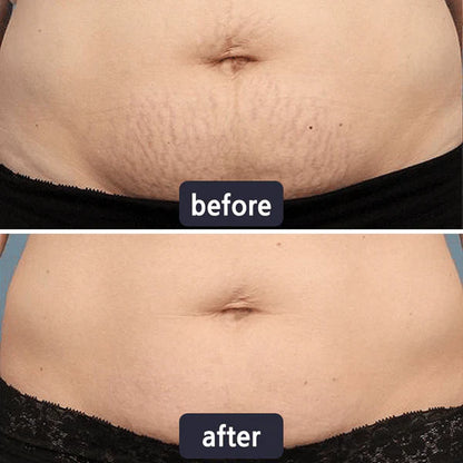 Alisanda Scar Removal Cream
