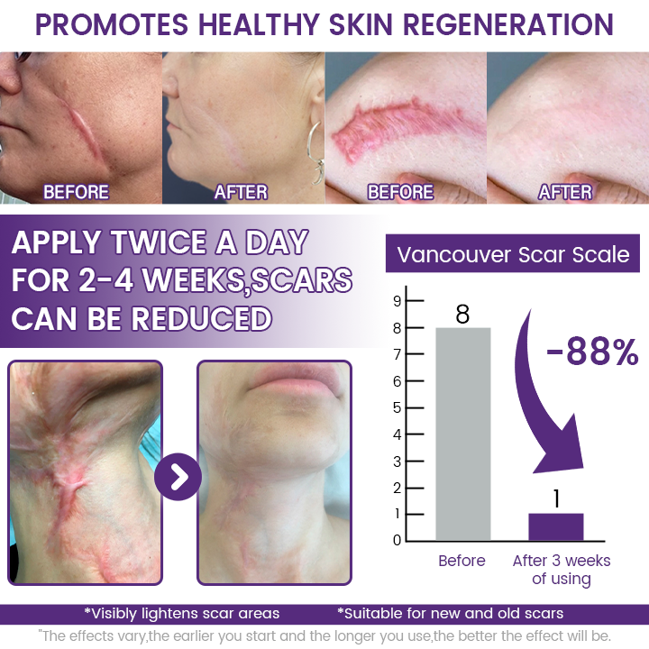 Alisanda® ReGenScar Rapid Recovery Scar Gel