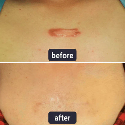 Alisanda Scar Removal Cream